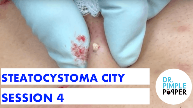 Steatocystoma City Slicker... Session Four