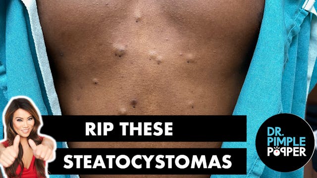 RIP These Steatocystomas