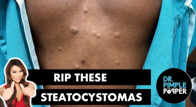 RIP These Steatocystomas