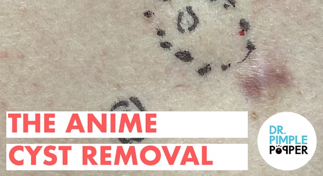 The Anime Cyst Removal 