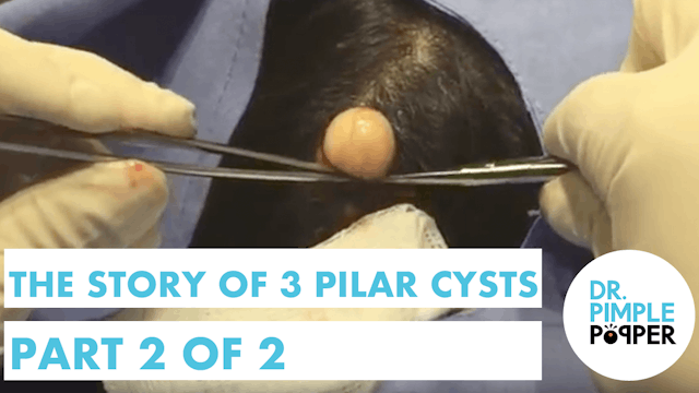 The Story of 3 Pilar Cysts: Part 2 of 2