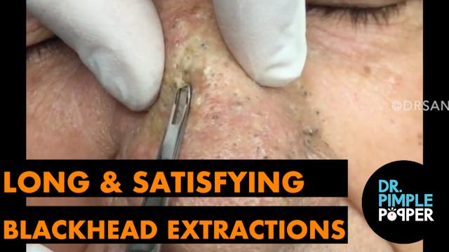 Long and Satisfying Blackhead Extract...