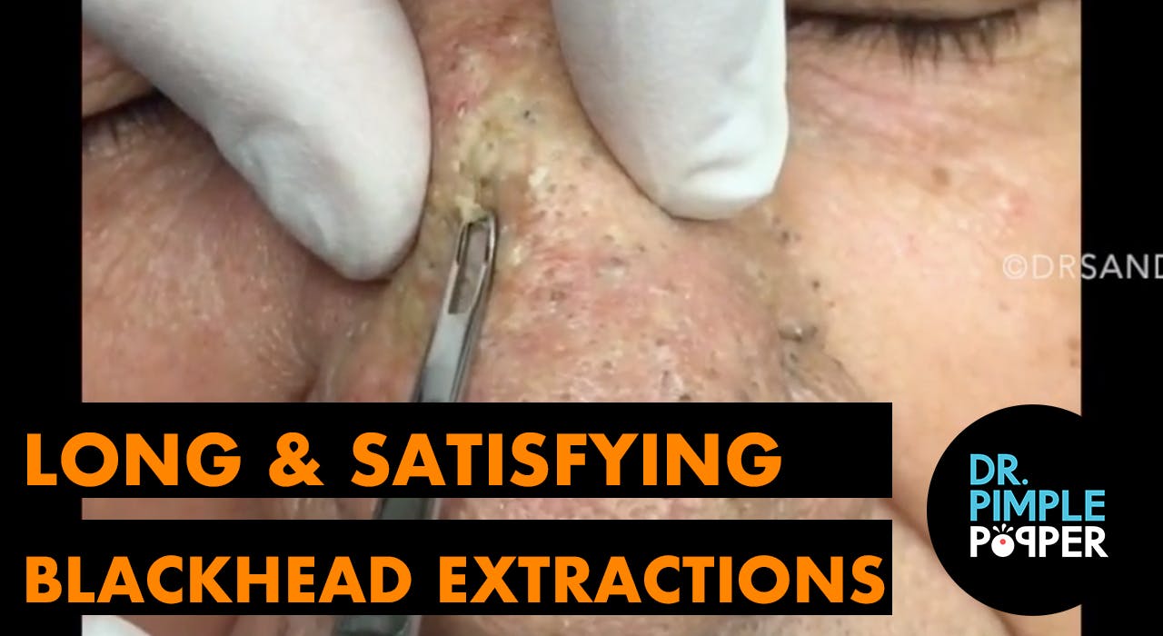 Long and Satisfying Blackhead Extractions: A Dr Popper Compilation Blackheads & Whiteheads Galore - Dr. Pimple Popper