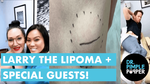 Larry the Lipoma + Special Guests 