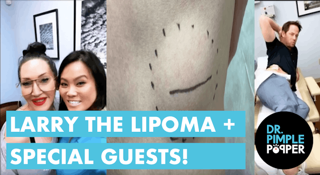 Larry the Lipoma + Special Guests 