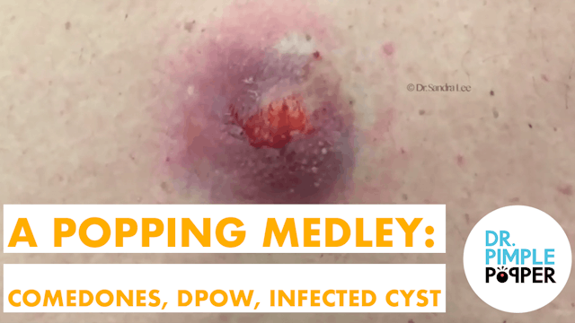 A Popping Medley: Comedones, Dilated Pore of Winer, Infected Cyst