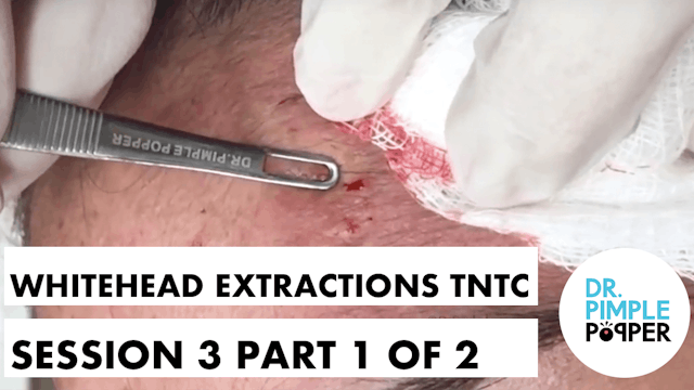 Whitehead Extractions TNTC, Session 3...