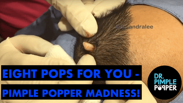 Eight Pops for You - Pimple Popper Madness