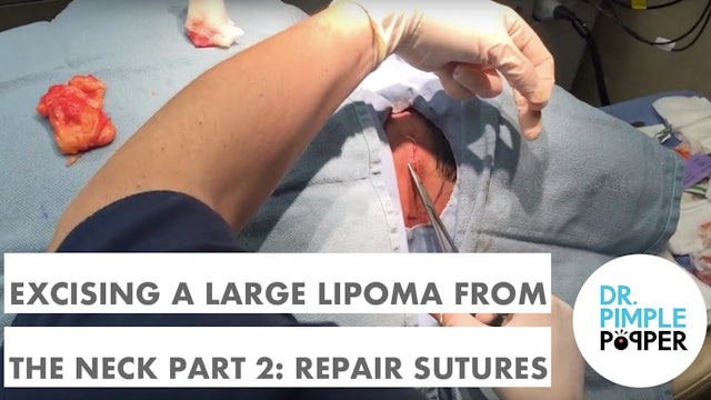 Dr Rebish excises a large lipoma on the neck, Part 2 - Sutures