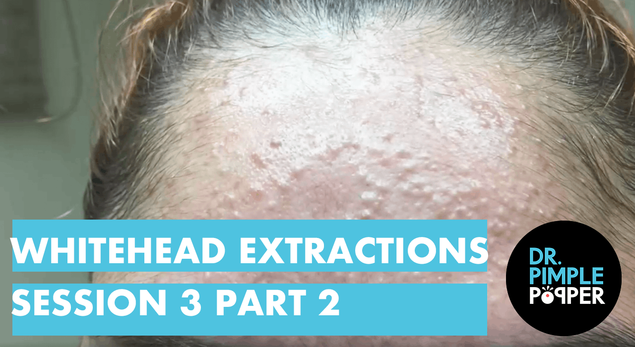 Whitehead Extractions TNTC Part 2 Dr. Pimple Popper