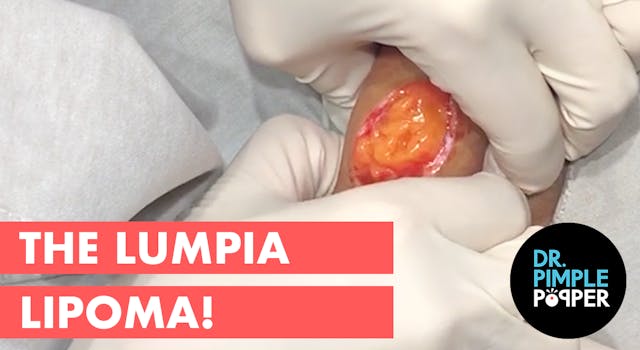 The Lumpia Lipoma