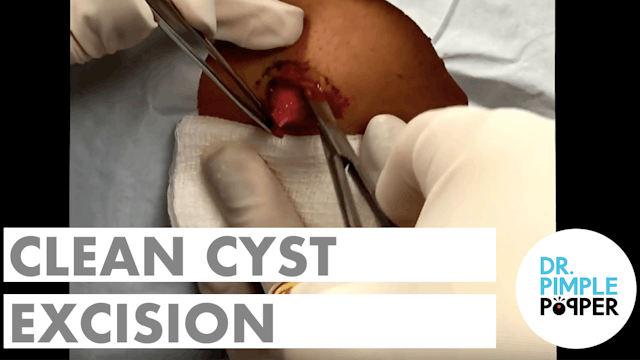 Clean Cyst Excision