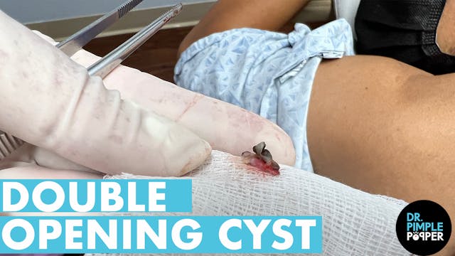 Double Opening Back Cyst!