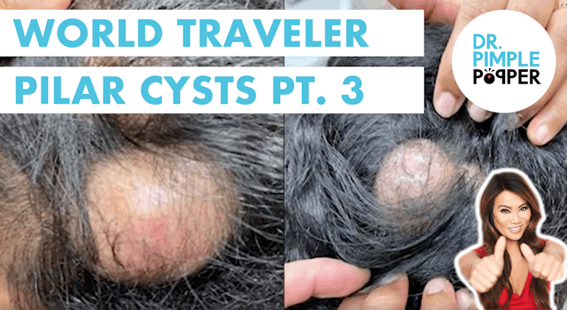 World Traveler Pilar Cysts Part 3