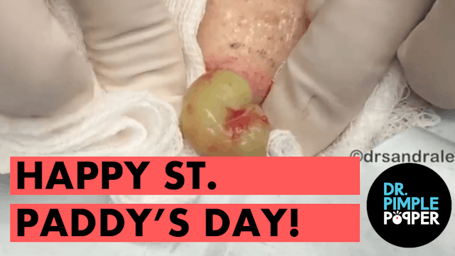 💚🍀 A Dr Pimple Popper St. Paddy's Day!! 🍀💚