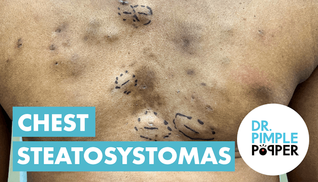 Steatocystomas and a Surprise!