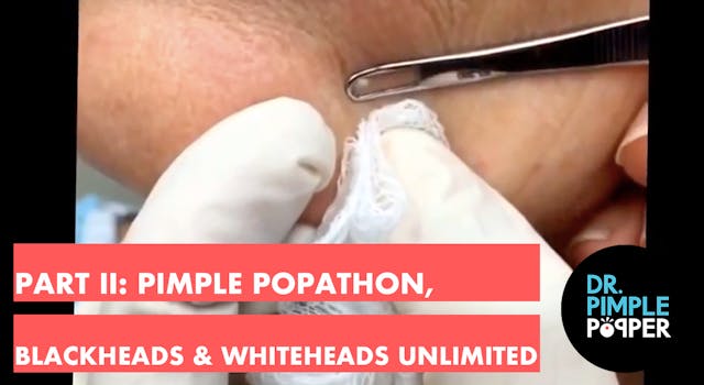 Part II: Pimple Popathon. Blackheads ...