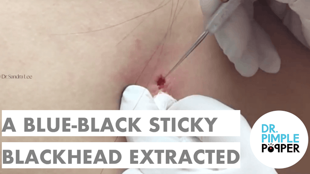 A blue-black, sticky blackhead extracted