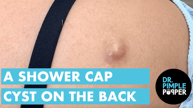 A Shower Cap Cyst on the Back