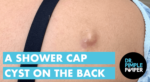 A Shower Cap Cyst on the Back