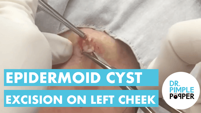 Epidermoid Cyst Excision on Left Cheek
