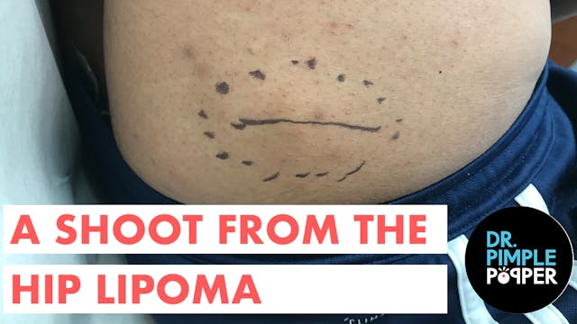 A Shoot from the Hip Lipoma