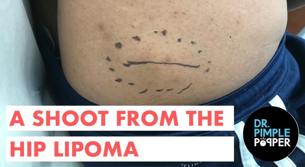 a-shoot-from-the-hip-lipoma-lipoma-love-dr-pimple-popper