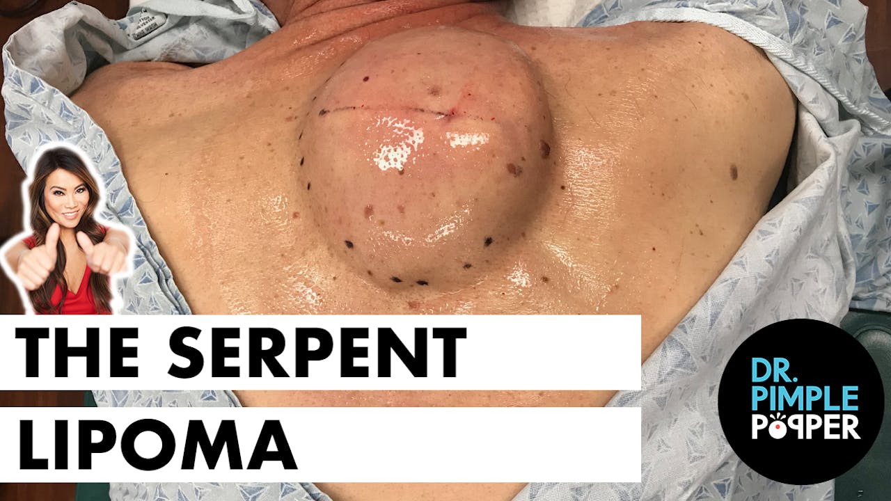 The Serpent Lipoma - Lipoma Love - Dr. Pimple Popper