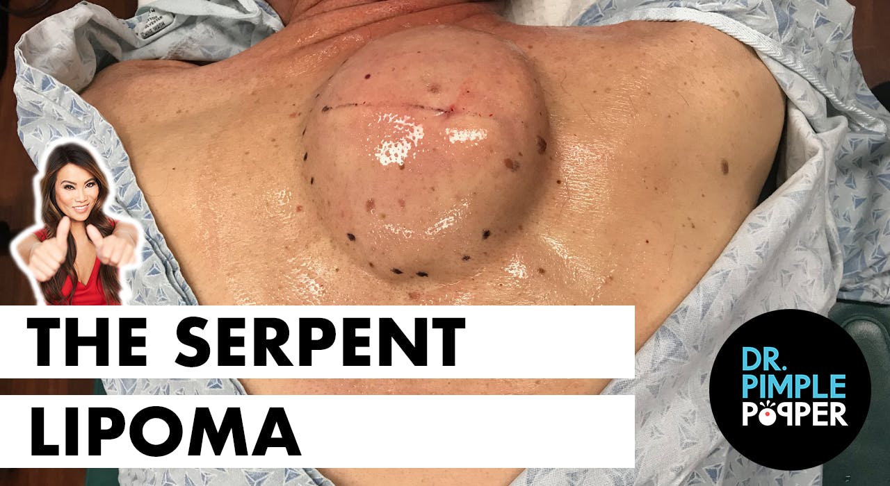 The Serpent Lipoma - Lipoma Love - Dr. Pimple Popper