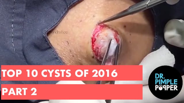 Dr Pimple Popper's Top 10 Cysts of 20...