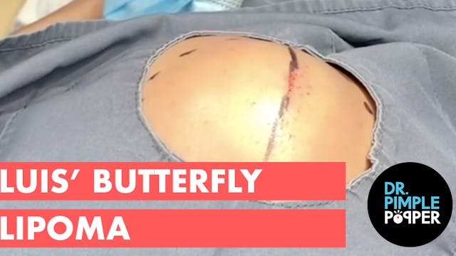 Luis' Butterfly Lipoma
