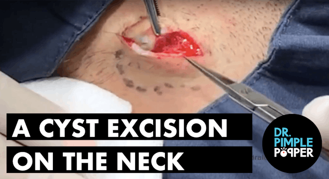 A Piggyback Cyst Excision on the Neck