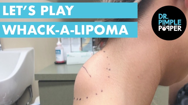 Let's Play Whack-A-Lipoma!