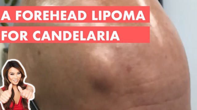 A Forehead Lipoma for Candelaria