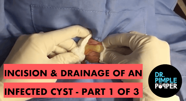 Incision & Drainage of an Infected Cyst (Part 1)
