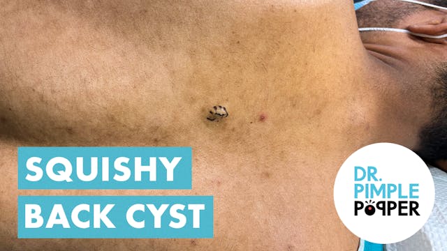 A Little Baby Squish Cyst!