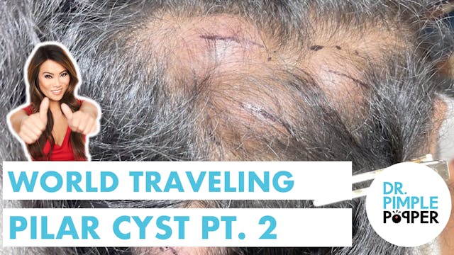 World Traveling Pilar Cyst: Part 2