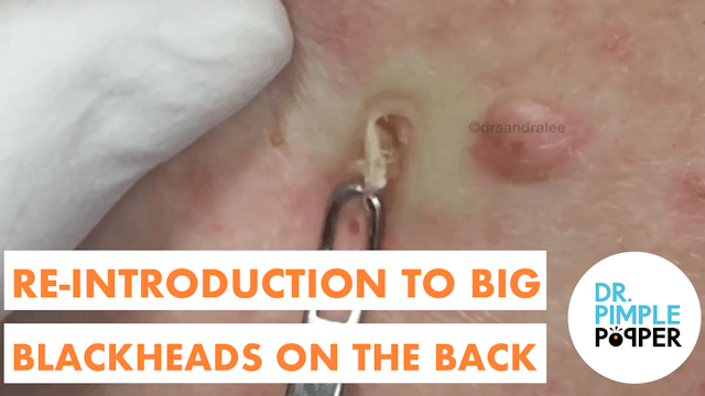 Reintroduction to Big Back Blackheads