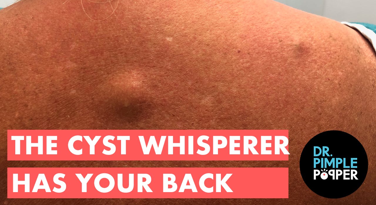 The Cyst Whisperer Has Your Back Recently Added Dr. Pimple Popper
