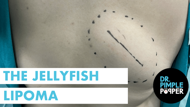 The Jellyfish Lipoma