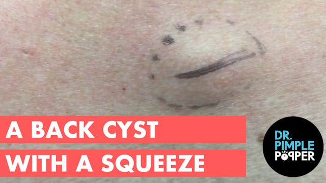 A Back Cyst with a Squeeze