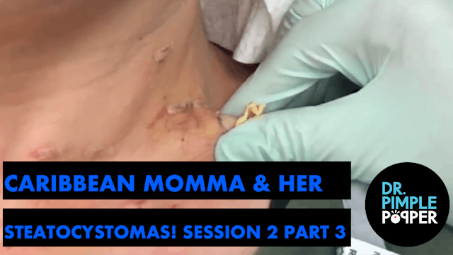 Caribbean Momma and her Steatocystomas: Session Two, Part 3 (plus PIMPLE PETE)