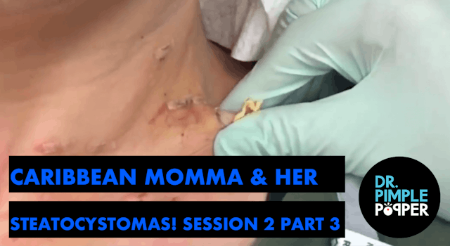 Caribbean Momma and her Steatocystomas: Session Two, Part 3 (plus PIMPLE PETE)