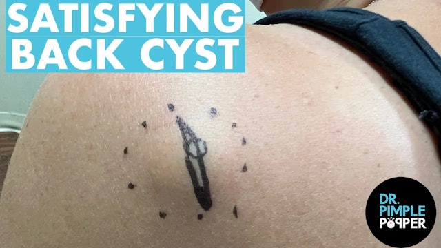 SATISFYING Cyst Removal