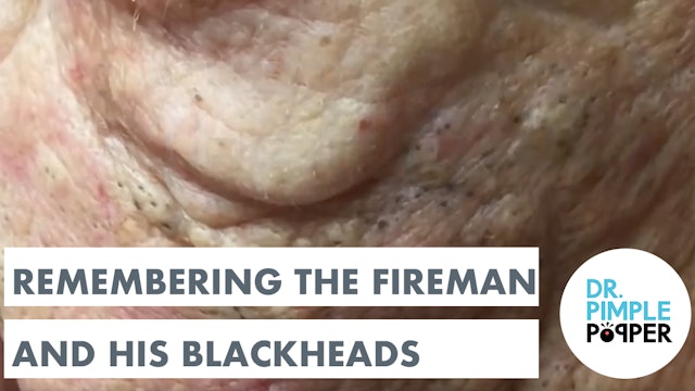 Remembering the Fireman and his Blackheads