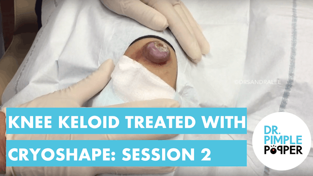 Knee Keloid Treated with Cryoshape - Session 2