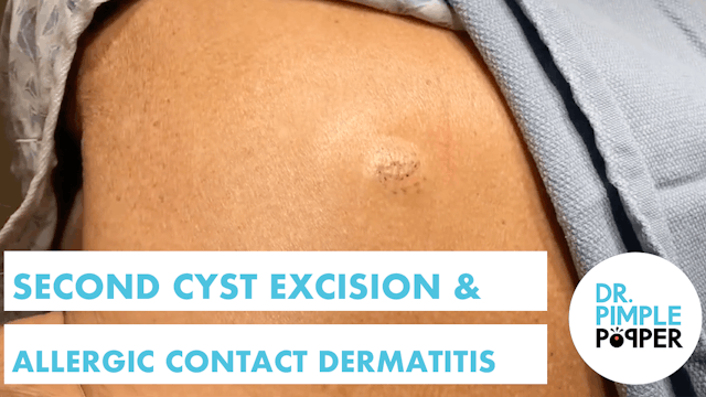 Second Cyst Excision & Allergic Conta...