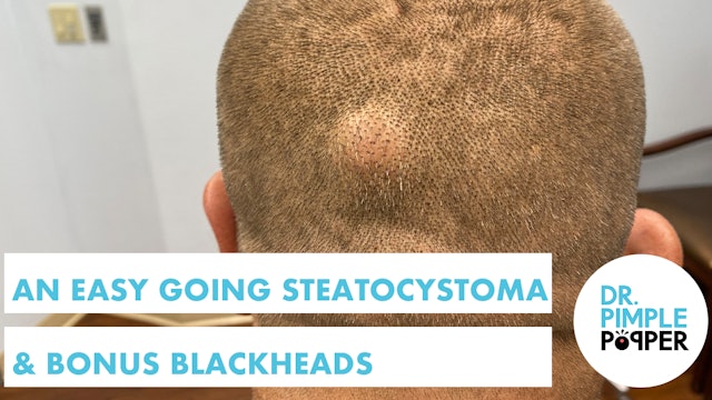 An Easy Going Steatocystoma... AND Bonus Blackheads!