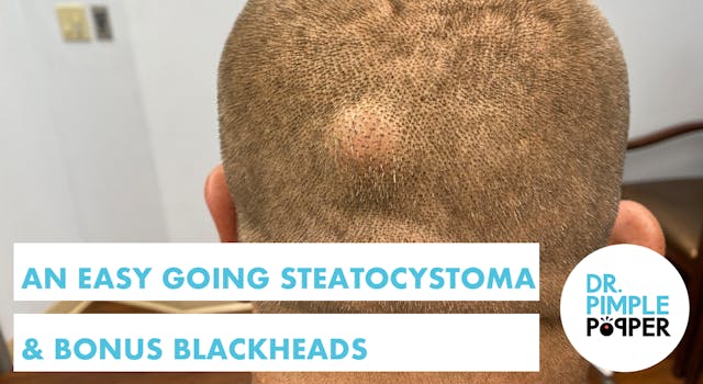 An Easy Going Steatocystoma... AND Bo...