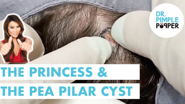 Princess & The Pilar Pea Cyst